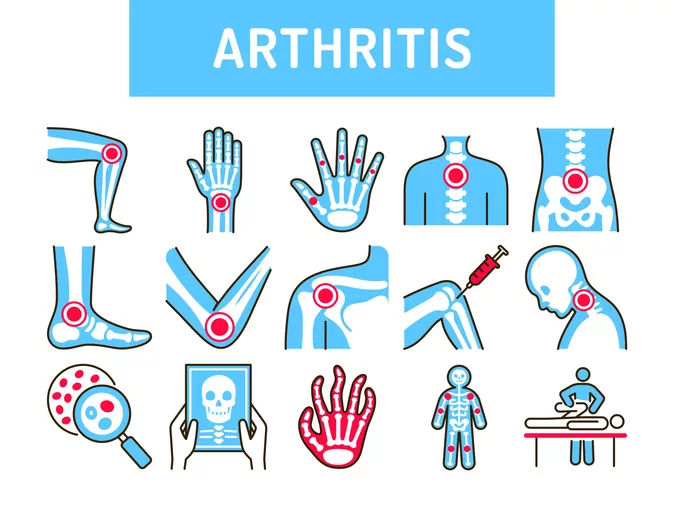 Everything About Arthritis: Causes, Symptoms, and an In-Depth Guide to Treatment