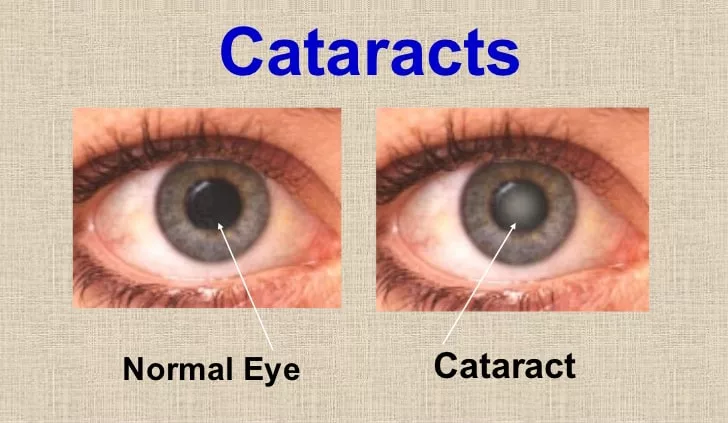 A Clear Understanding of Cataracts: Causes and Treatments