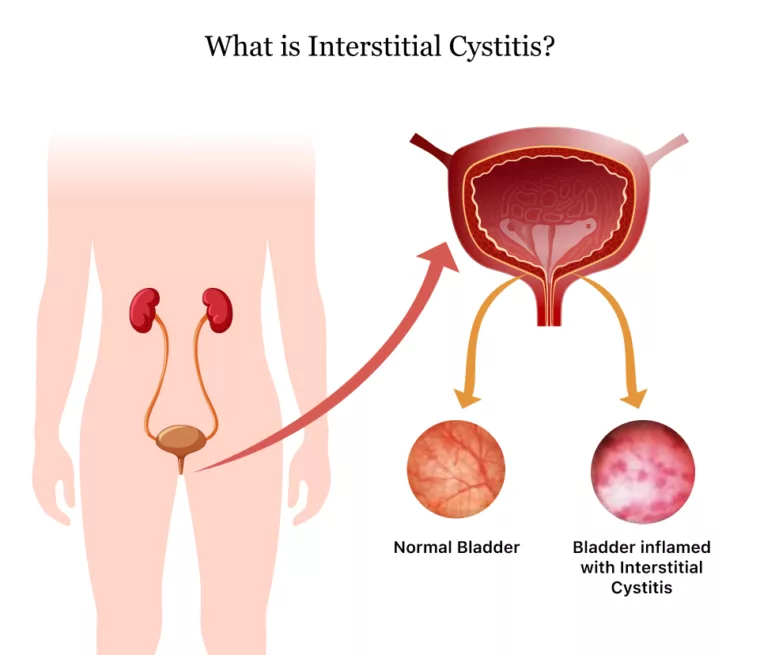 Cystitis