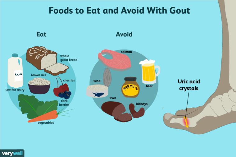 Foods Gout