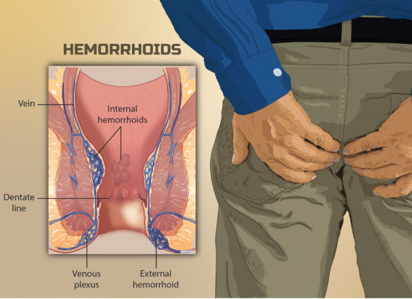 Unknown Causes of Hemorrhoids: Do Daily Habits Lead to Hemorrhoids?