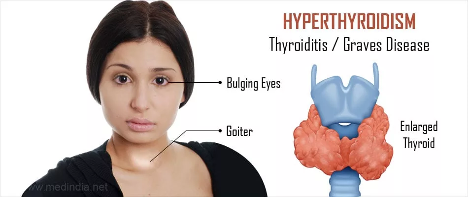 Hyperthyroidism: Causes, Symptoms, and Weight Management Methods