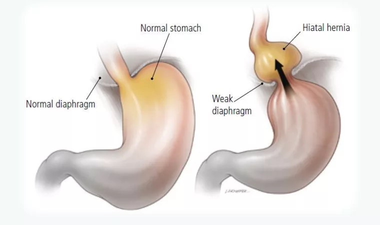 Reflux