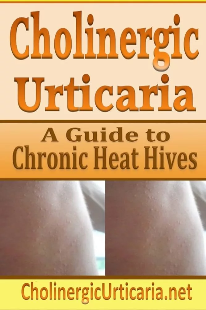 Cholinergic Urticaria: Causes, Symptoms, and Treatment Methods