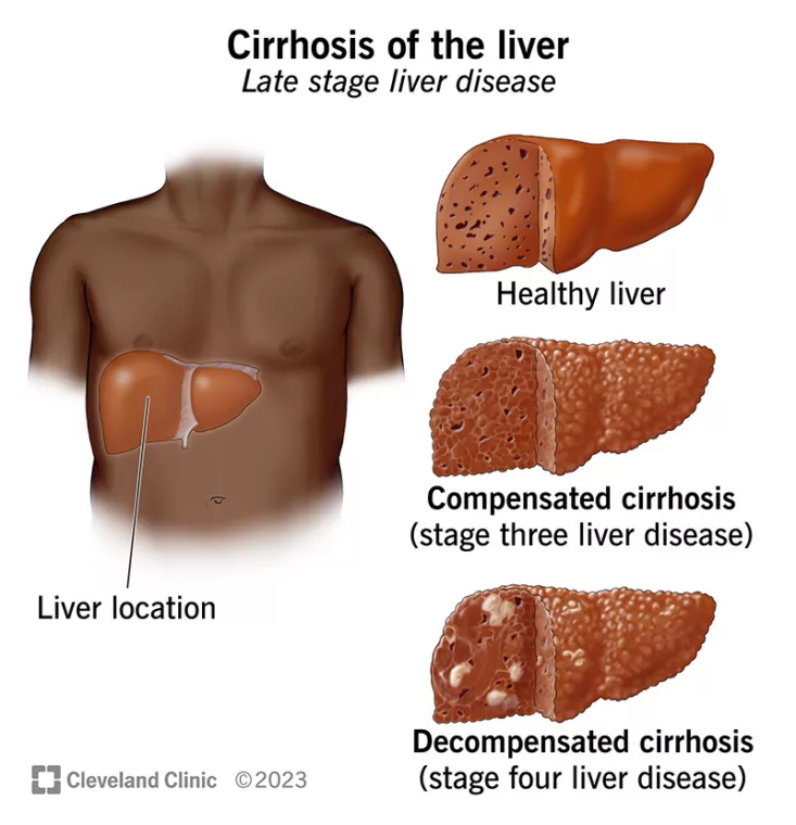 Cirrhosis