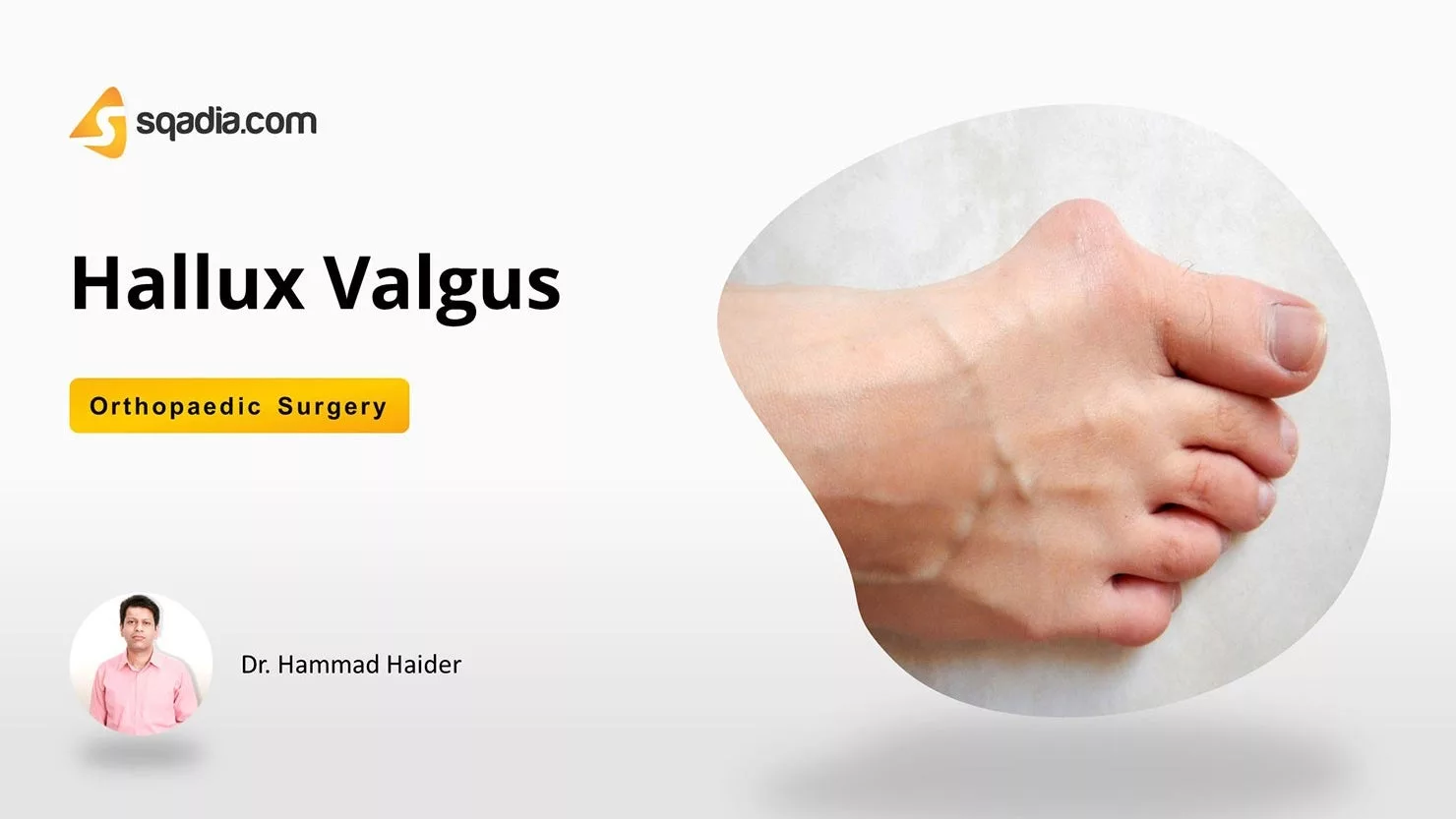 Overcoming Hallux Valgus Without Surgery