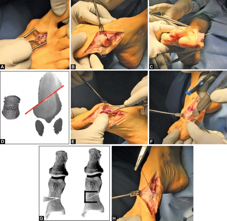 Hallux Valgus