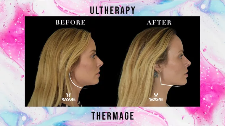 Ultherapy vs. Thermage