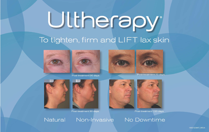 Ultherapy vs. Thermage