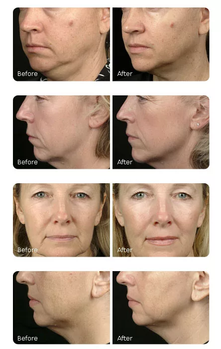 Ultherapy vs. Thermage