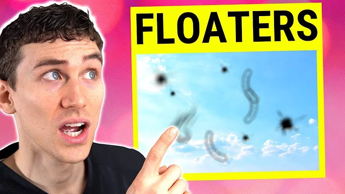 Overcoming Floaters!