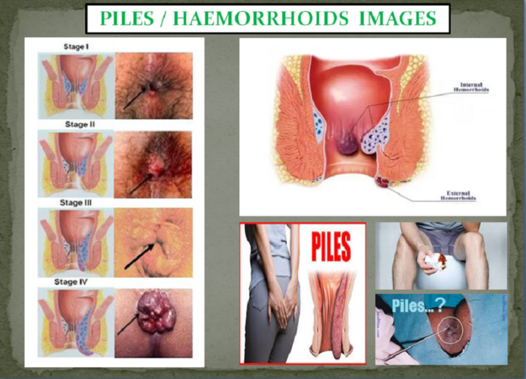 Hemorrhoids