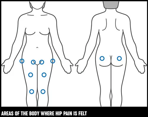 Hip Pain