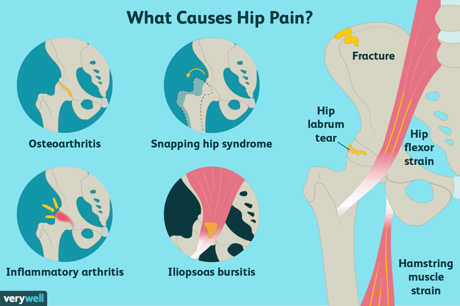 Causes and Treatments of Hip Pain