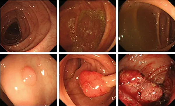 colorectal polyps