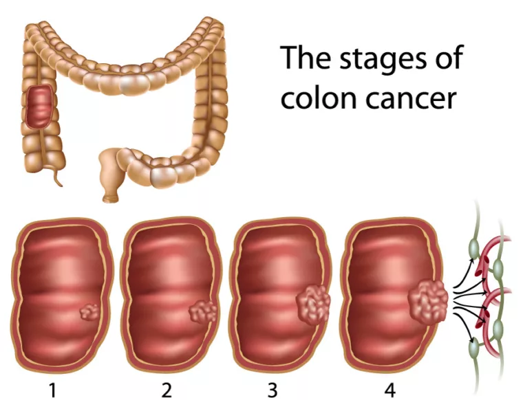 colorectal polyps