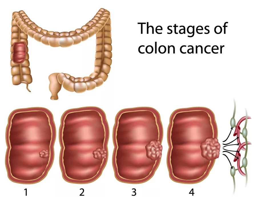 Everything About Colorectal Polyps