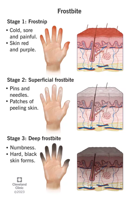 Frostbite