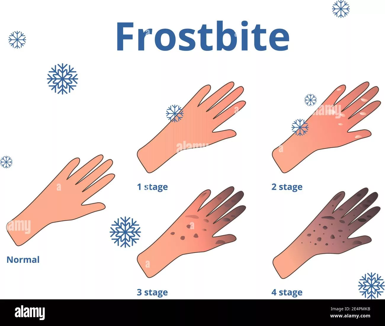 Early Symptoms and Treatment of Frostbite