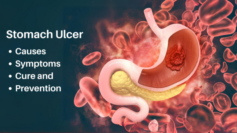 helicobacter pylori