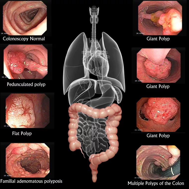 colorectal polyps