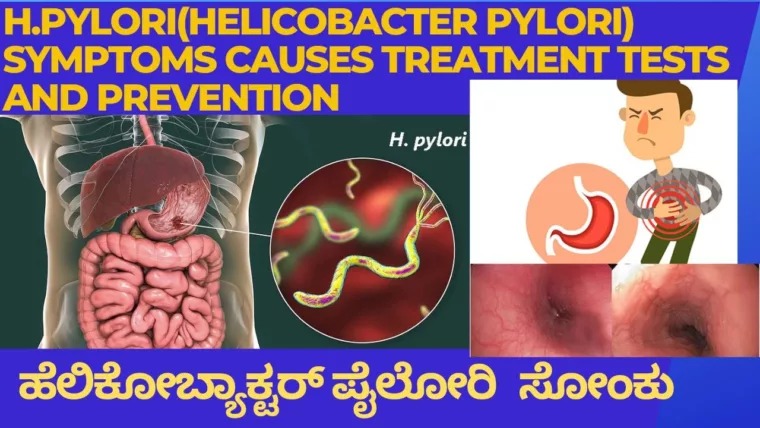 helicobacter pylori