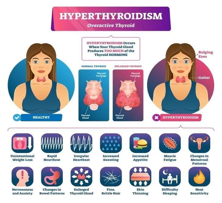 Thyroid Nodules