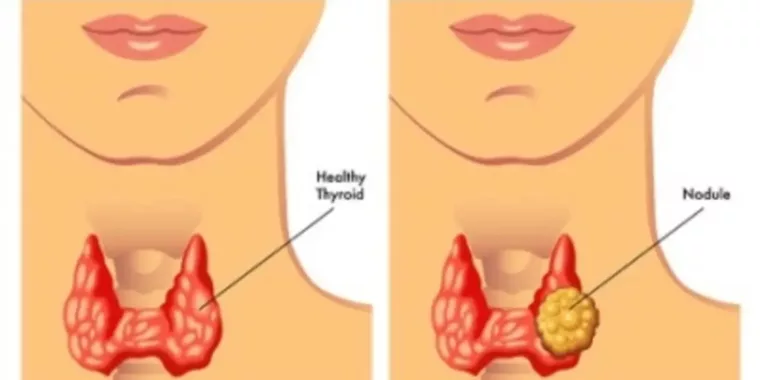 Thyroid Nodules