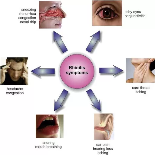 Allergic Rhinitis