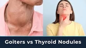 Thyroid Nodules